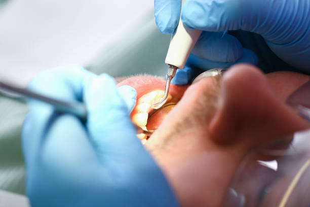 Best Emergency Dental Extractions in Roosevelt Park, MI
