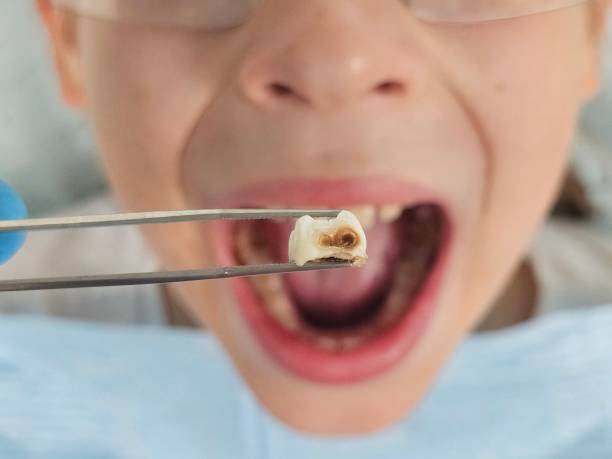 Best Emergency Dentist for Lost Fillings or Crowns in Roosevelt Park, MI
